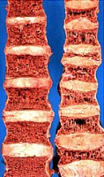 Spine showing severe osteoporosis